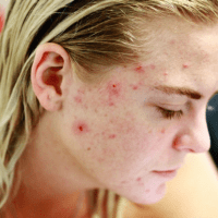 skin problem